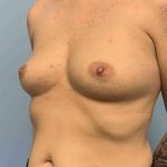 Breast Augmentation Before & After Patient #12227
