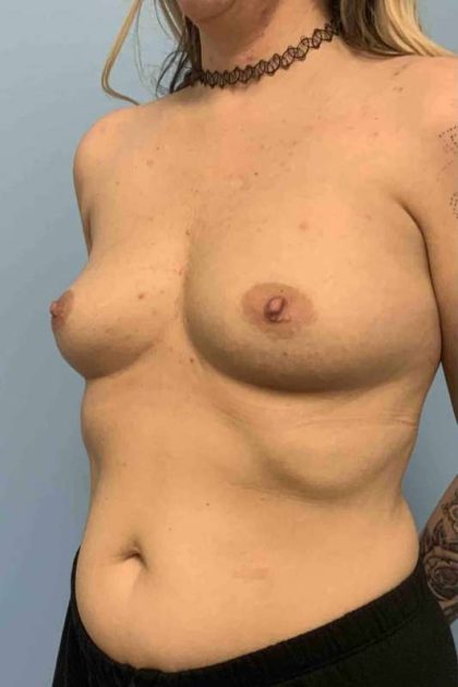 Breast Augmentation Before & After Patient #12227