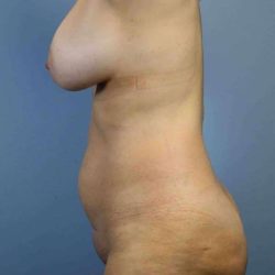 Breast Augmentation Before & After Patient #12239