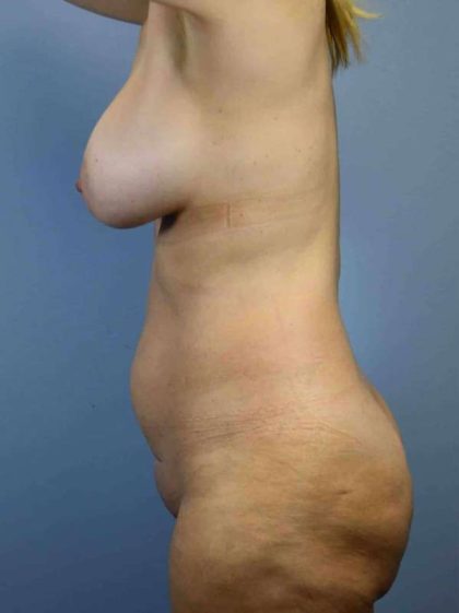 Breast Augmentation Before & After Patient #12239