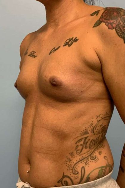 Breast Augmentation Before & After Patient #12253
