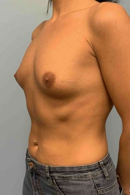Breast Augmentation Before & After Patient #12330