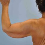 Brachioplasty Before & After Patient #12335