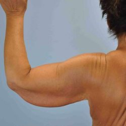 Brachioplasty Before & After Patient #12335