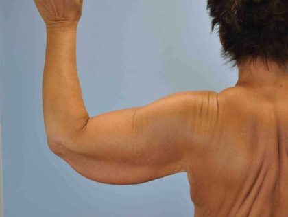 Brachioplasty Before & After Patient #12335