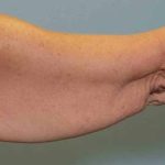 Brachioplasty Before & After Patient #12353