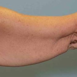 Brachioplasty Before & After Patient #12353
