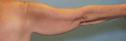 Brachioplasty Before & After Patient #12353