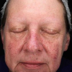 BBL Forever Young Before & After Patient #12386