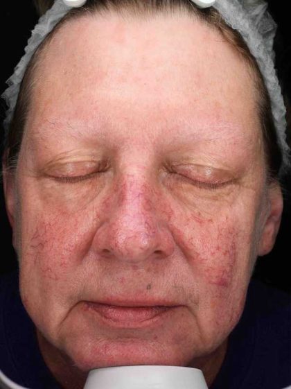 BBL Forever Young Before & After Patient #12386