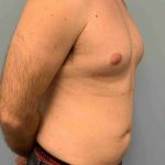 VASER Liposelection Before & After Patient #10434