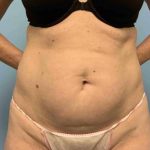 VASER Liposelection Before & After Patient #10446