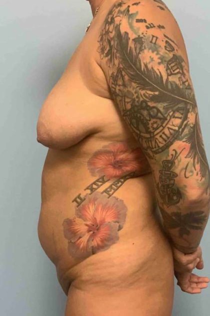 VASER Liposelection Before & After Patient #10479