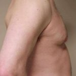 VASER Liposelection Before & After Patient #10486