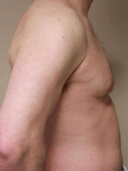 VASER Liposelection Before & After Patient #10486