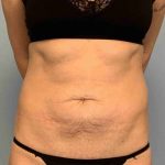 VASER Liposelection Before & After Patient #10493