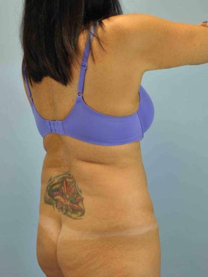 VASER Liposelection Before & After Patient #10511