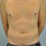 VASER Liposelection Before & After Patient #10527