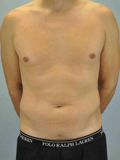 VASER Liposelection Before & After Patient #10527