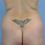 VASER Liposelection Before & After Patient #10543