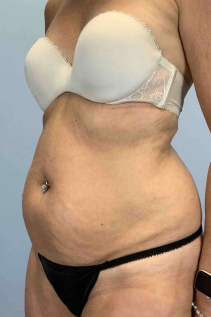 VASER Liposelection Before & After Patient #10407