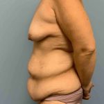 VASER Liposelection Before & After Patient #10561