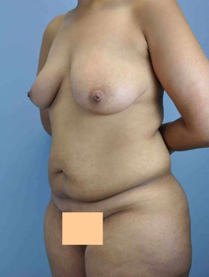 VASER Liposelection Before & After Patient #10568