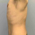 VASER Liposelection Before & After Patient #10602