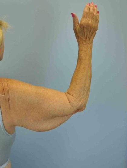 VASER Liposelection Before & After Patient #10615