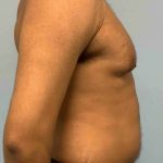 VASER Liposelection Before & After Patient #10622