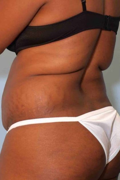 VASER Liposelection Before & After Patient #10631