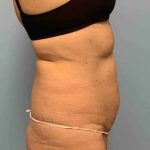 VASER Liposelection Before & After Patient #10638