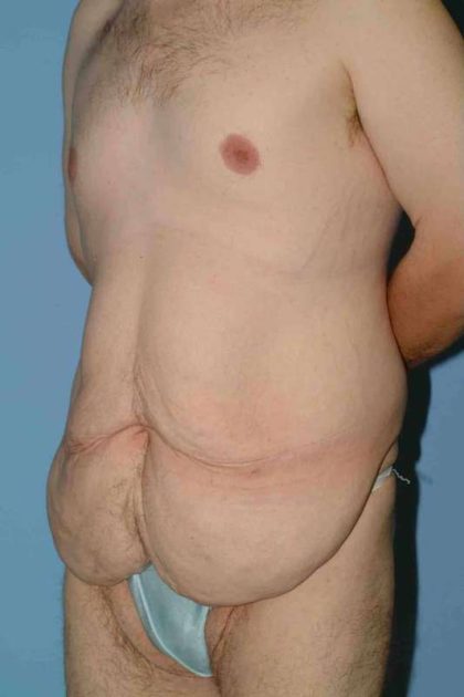 VASER Liposelection Before & After Patient #10400