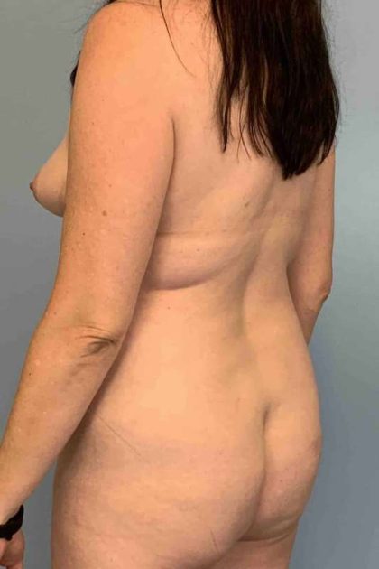VASER Liposelection Before & After Patient #10670