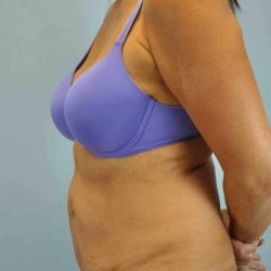 Tummy Tuck Before & After Patient #10675