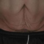 Tummy Tuck Before & After Patient #10689