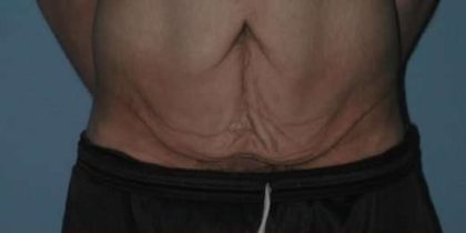 Tummy Tuck Before & After Patient #10689
