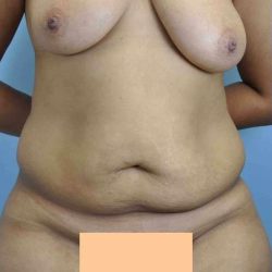 Tummy Tuck Before & After Patient #10807