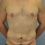 Tummy Tuck Before & After Patient #10846