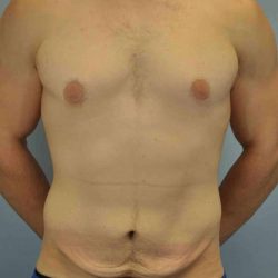 Tummy Tuck Before & After Patient #10846