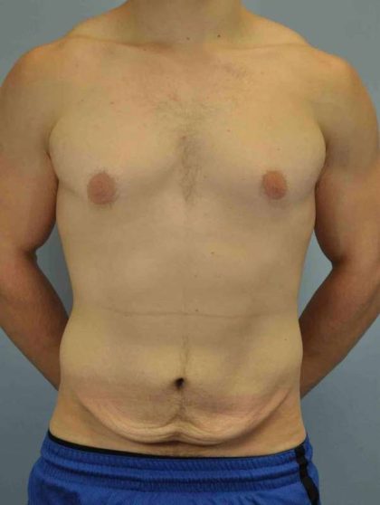 Tummy Tuck Before & After Patient #10846
