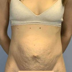 Tummy Tuck Before & After Patient #10862