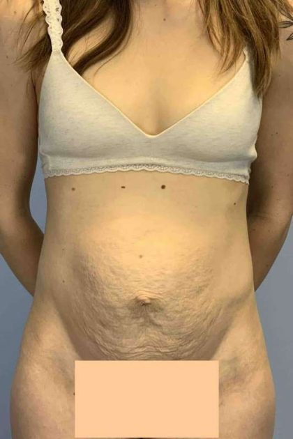 Tummy Tuck Before & After Patient #10862