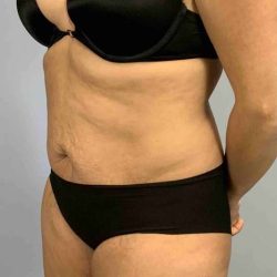 Tummy Tuck Before & After Patient #10869
