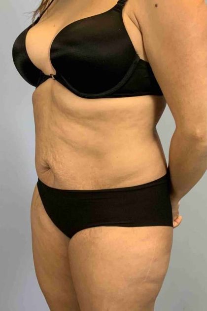 Tummy Tuck Before & After Patient #10869