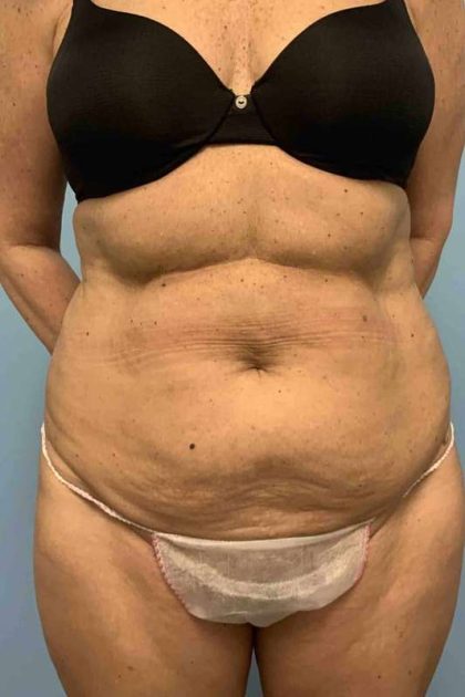 Tummy Tuck Before & After Patient #10881