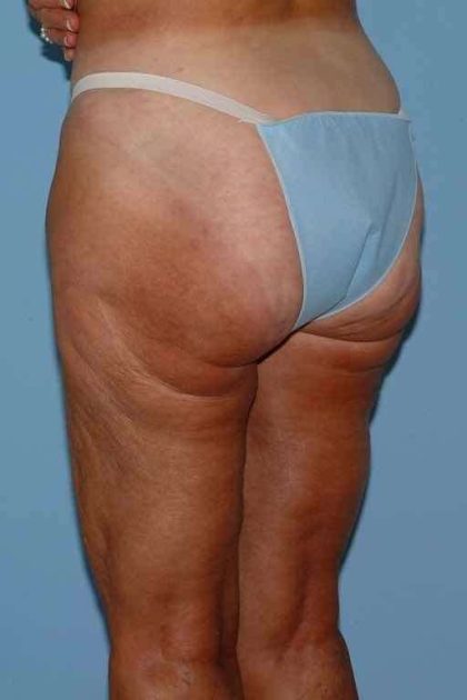 Thigh Surgery Before & After Patient #10890