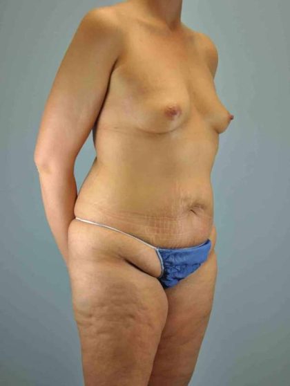 Thigh Surgery Before & After Patient #10900