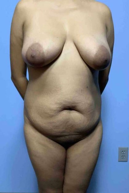 Renuvion Before & After Patient #10909
