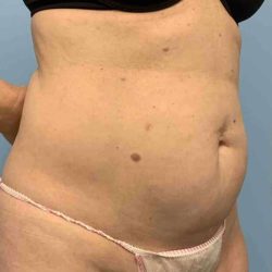 Renuvion Before & After Patient #10921